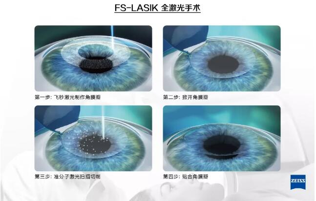 半飛秒激光近視眼手術